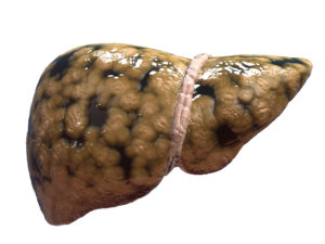 fatty-liver